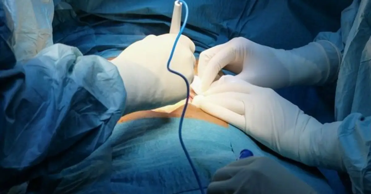 Abdominoperineal Resection in Chennai