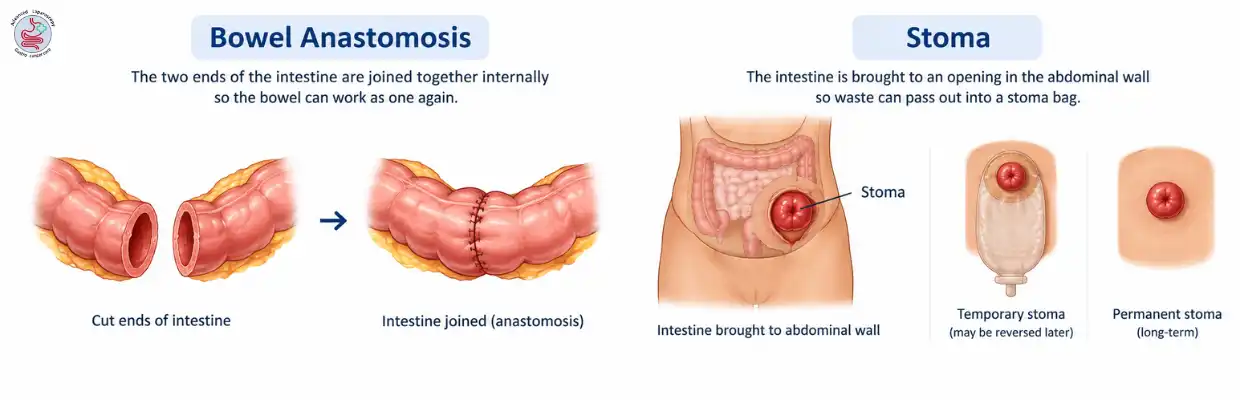 Bowel Resection & Anastomosis in chennai