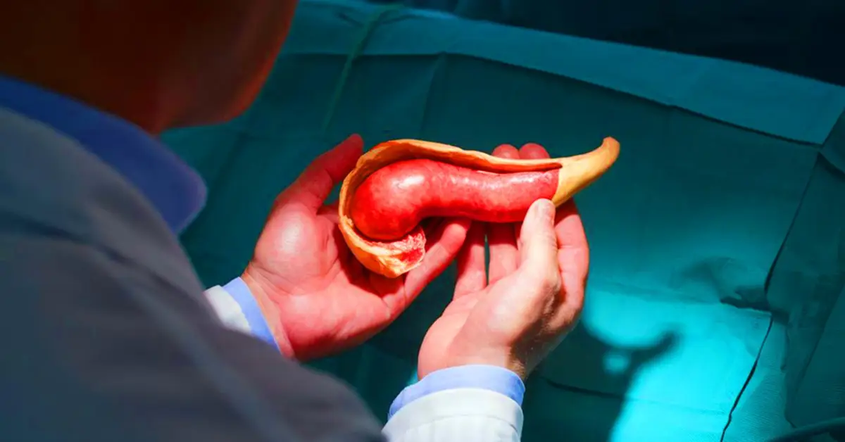 Colorectal Cancer Surgery in Chennai