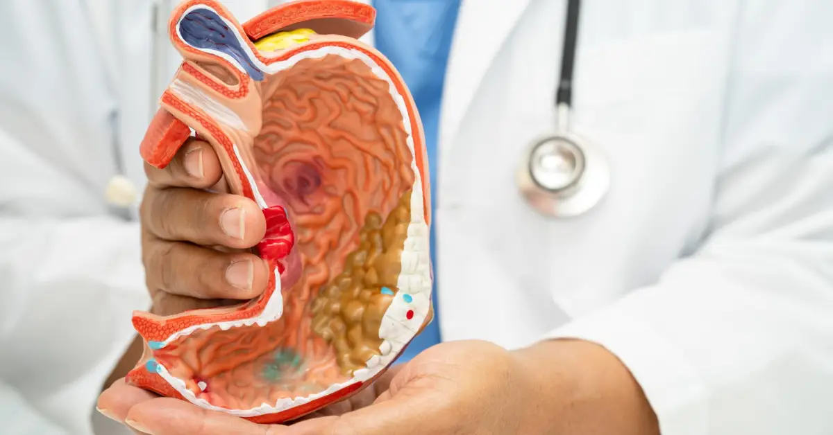 Fundoplication in Chennai