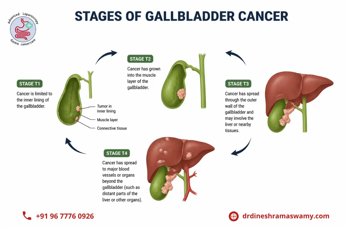 Gallbladder Cancer Surgery in Chennai