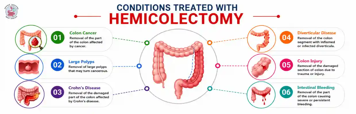 Hemicolectomy treatment in Chennai
