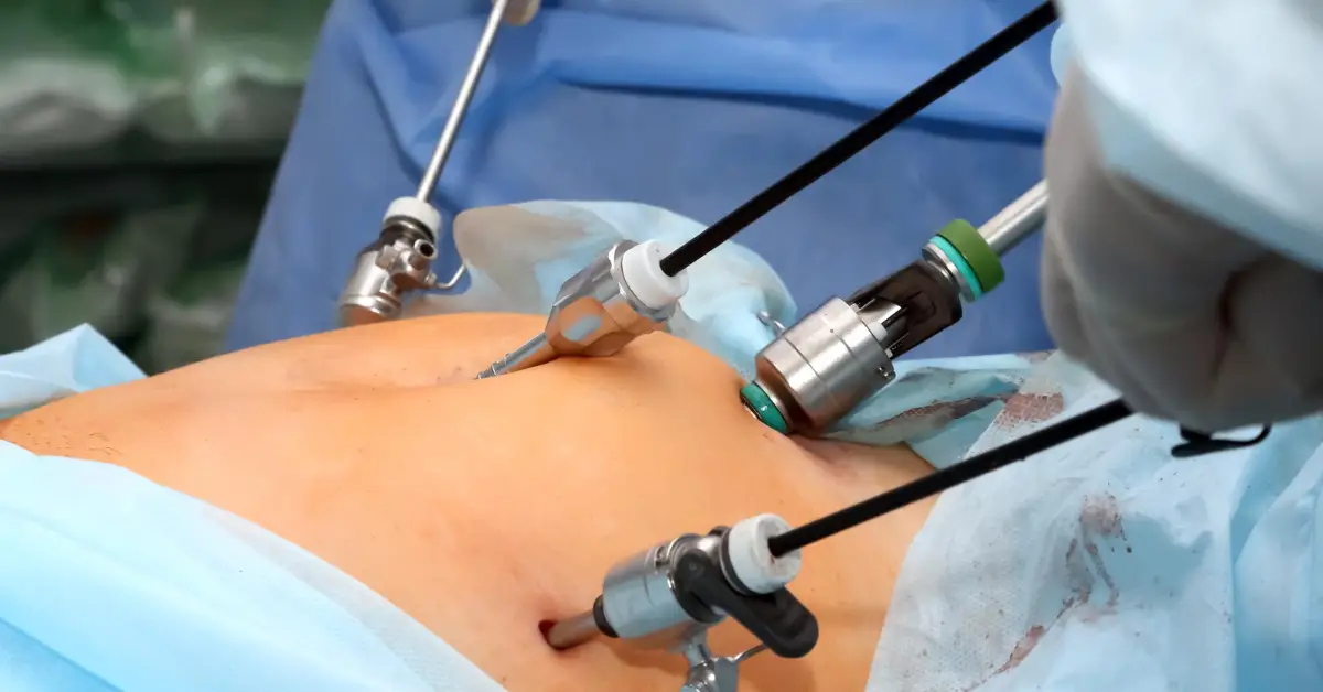 Laparoscopic Cholecystectomy in Chennai