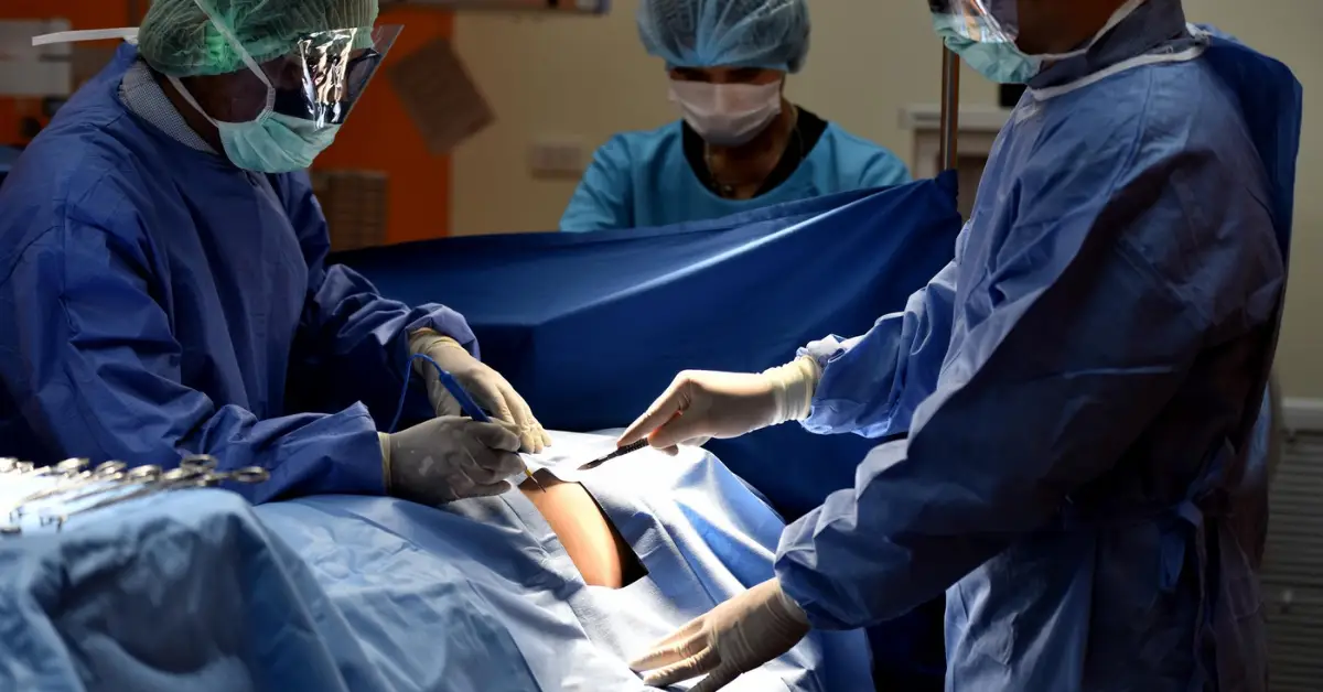 Laparoscopic Sleeve Gastrectomy in Chennai