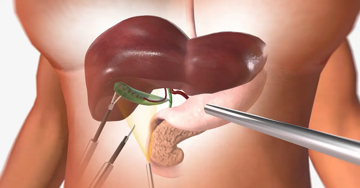 Radical Cholecystectomy in chennai