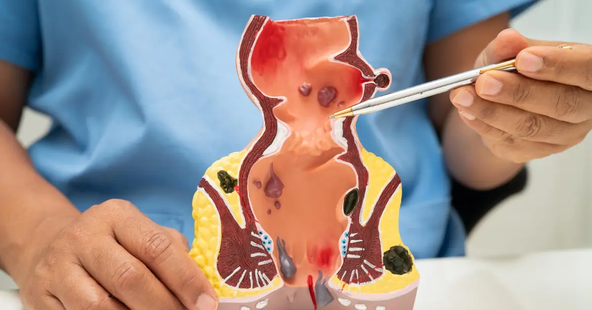 Small Bowel Tumors in Chennai