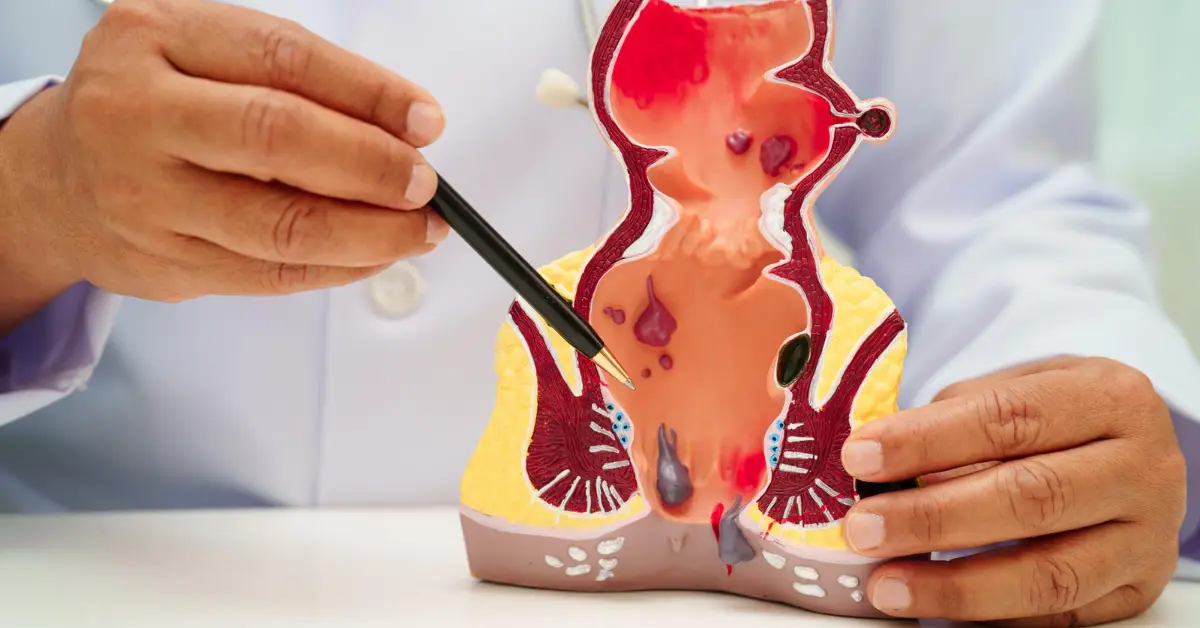 Total Proctocolectomy + IPAA in Chennai