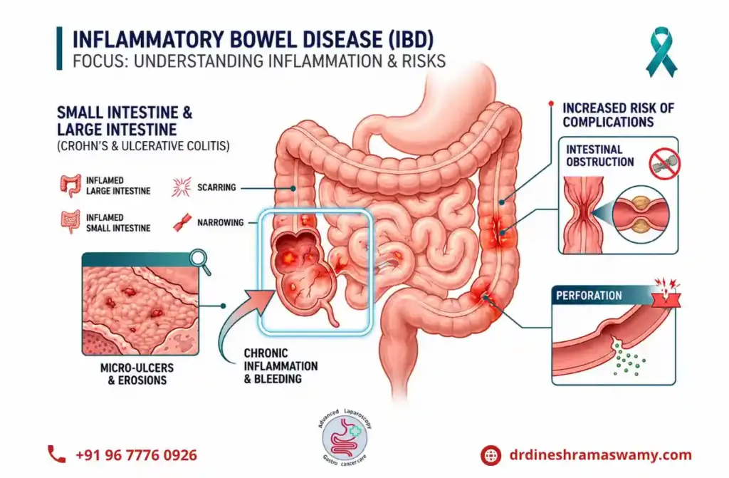 Inflammatory Bowel Disease (IBD)