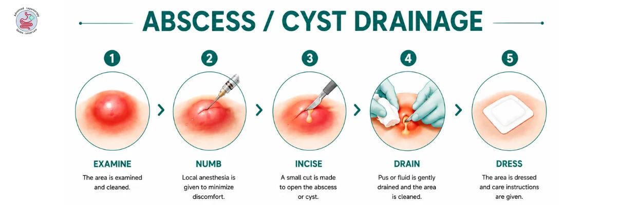 Abscess Cyst Drainage Treatment in chennai